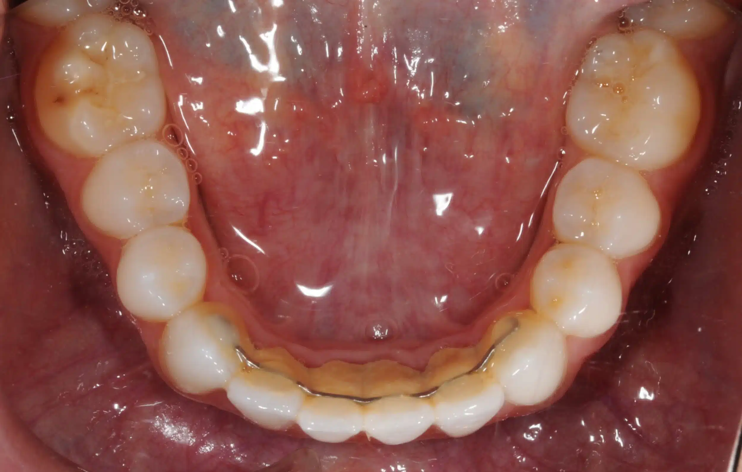 retention four years later relapse 5-25-2021 - 130950 - Ines Castro - Retention 40 - Occlusal Lower.jpg