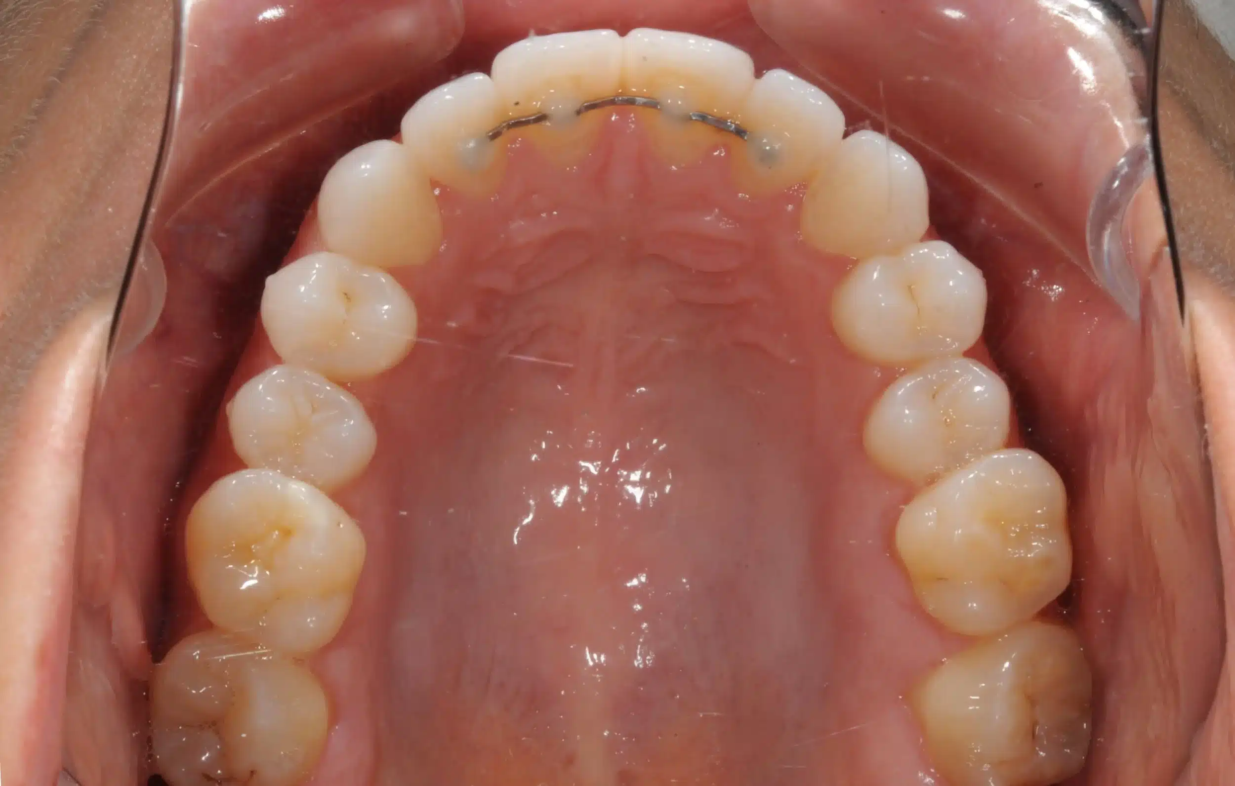 retention four years later relapse 5-25-2021 - 130950 - Ines Castro - Retention 40 - Occlusal Upper.jpg