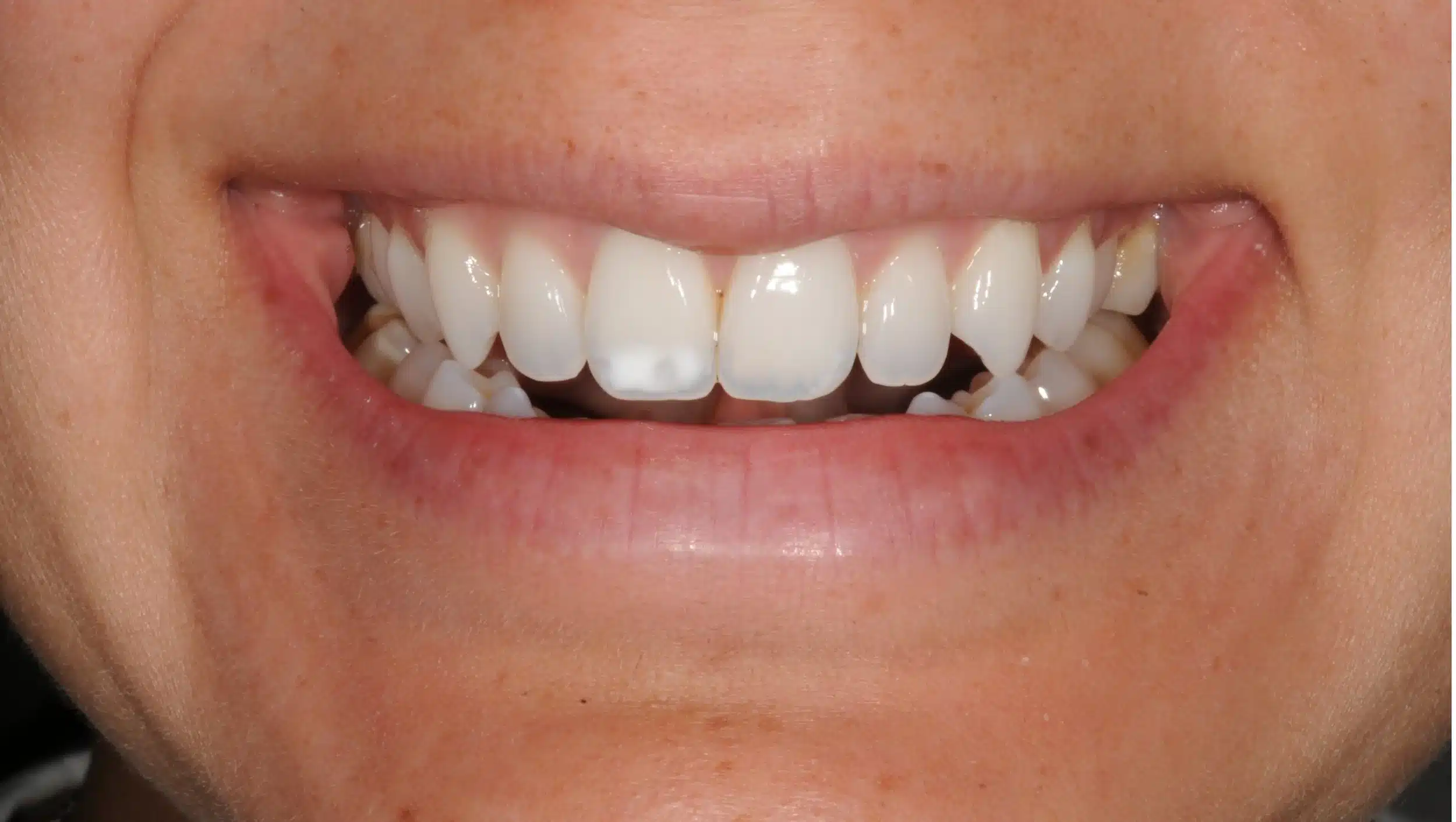 retention four years later relapse 5-25-2021 - 130950 - Ines Castro - Retention 40 - Smile.jpg