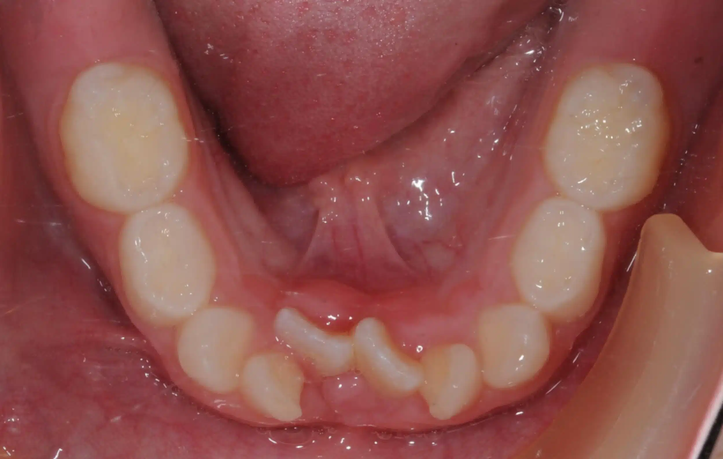 Why Early Orthodontics Treatment is essential (10).jpg