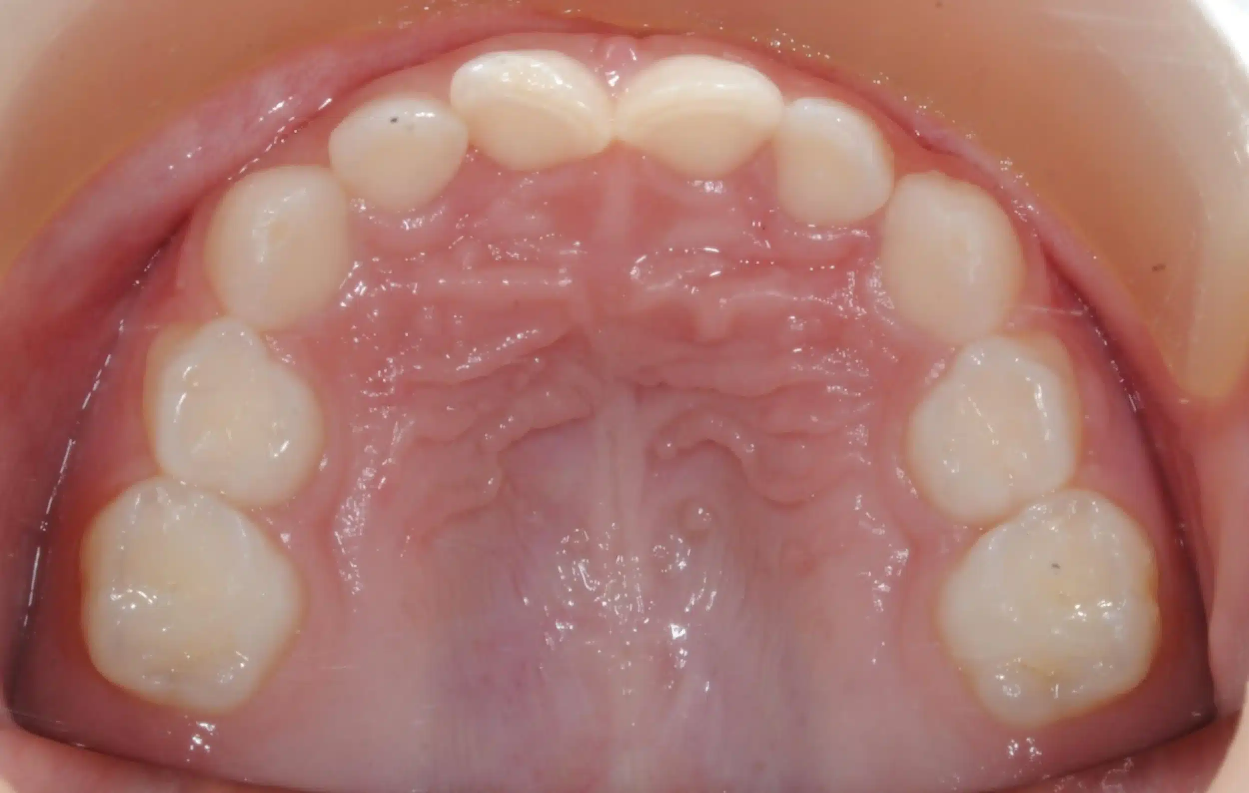 Why Early Orthodontics Treatment is essential (12).jpg