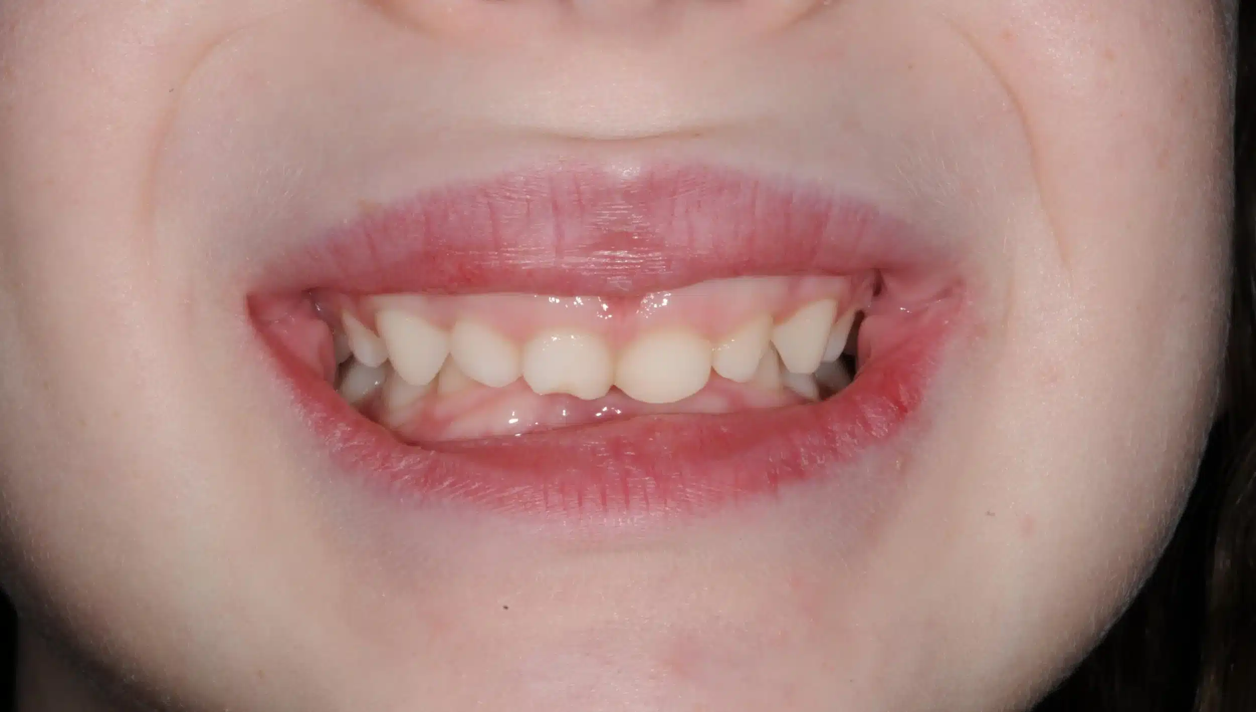 Why Early Orthodontics Treatment is essential (13).jpg