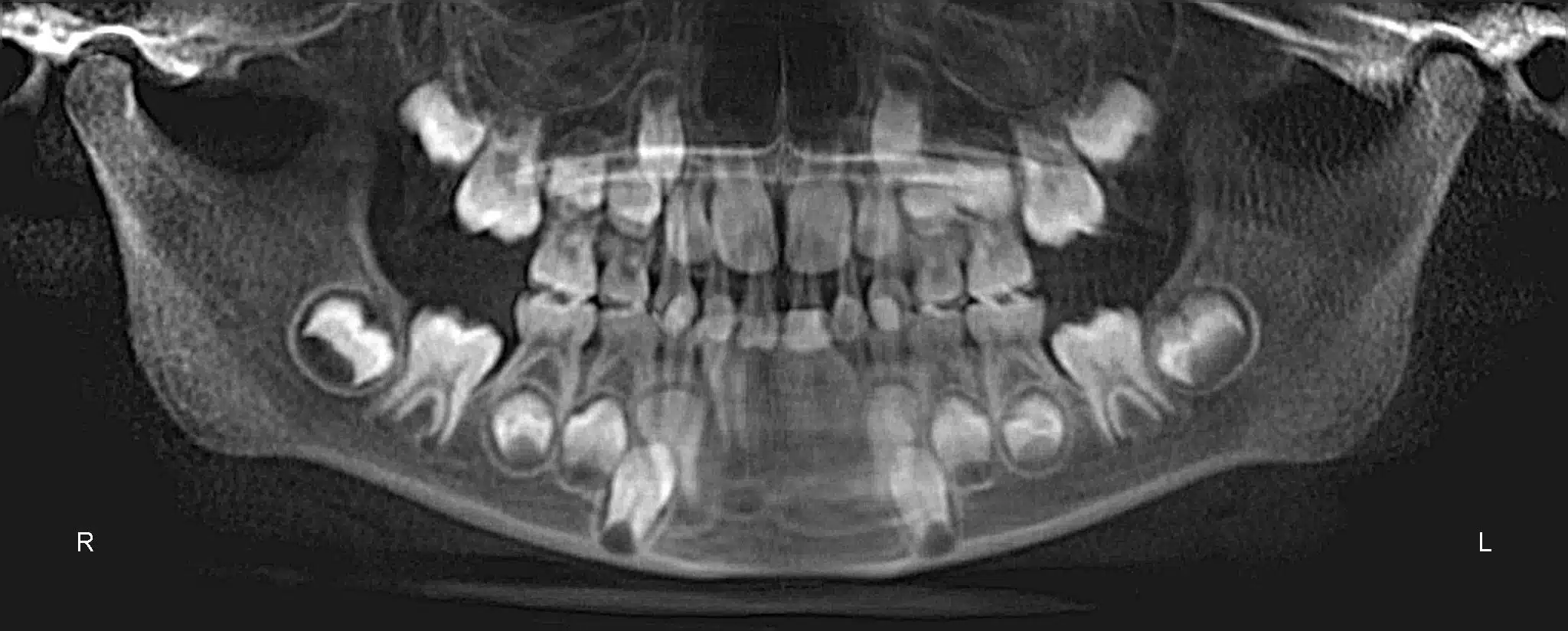 Why Early Orthodontics Treatment is essential (16).jpg