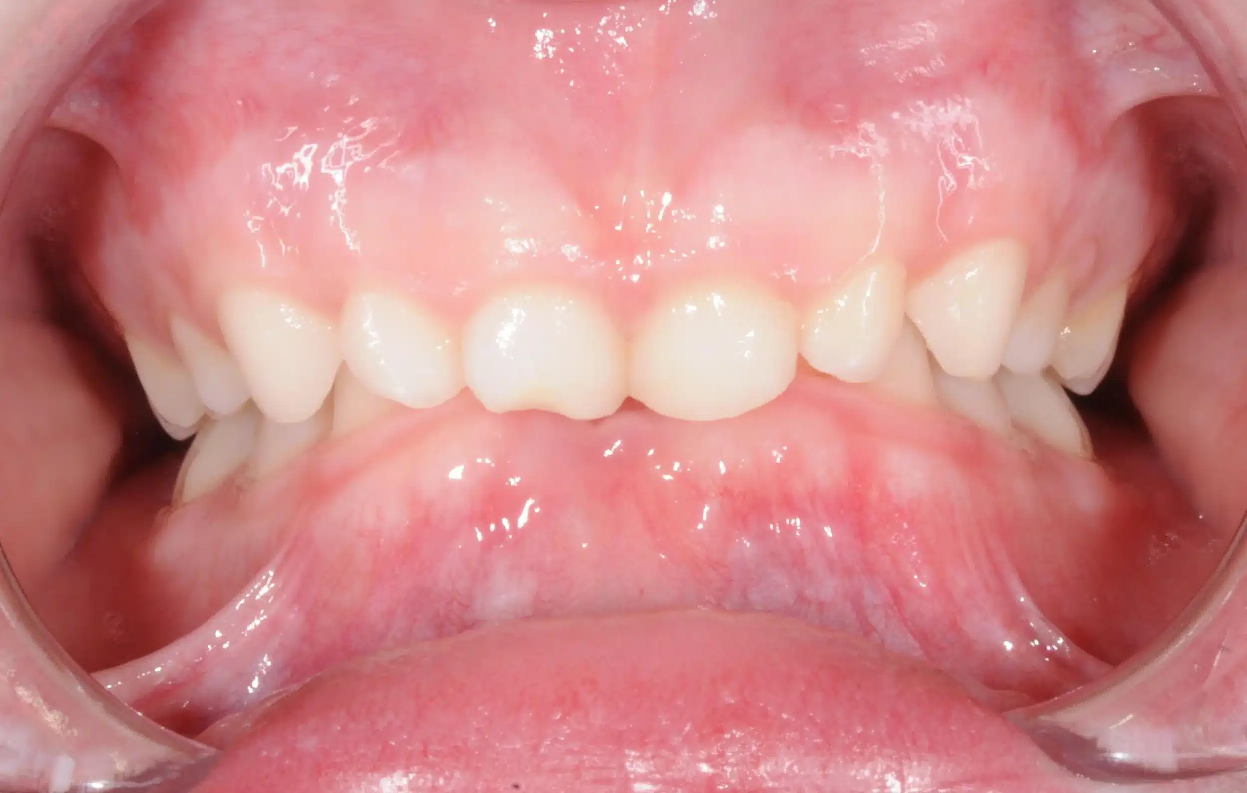 Why Early Orthodontics Treatment is essential (6).jpg