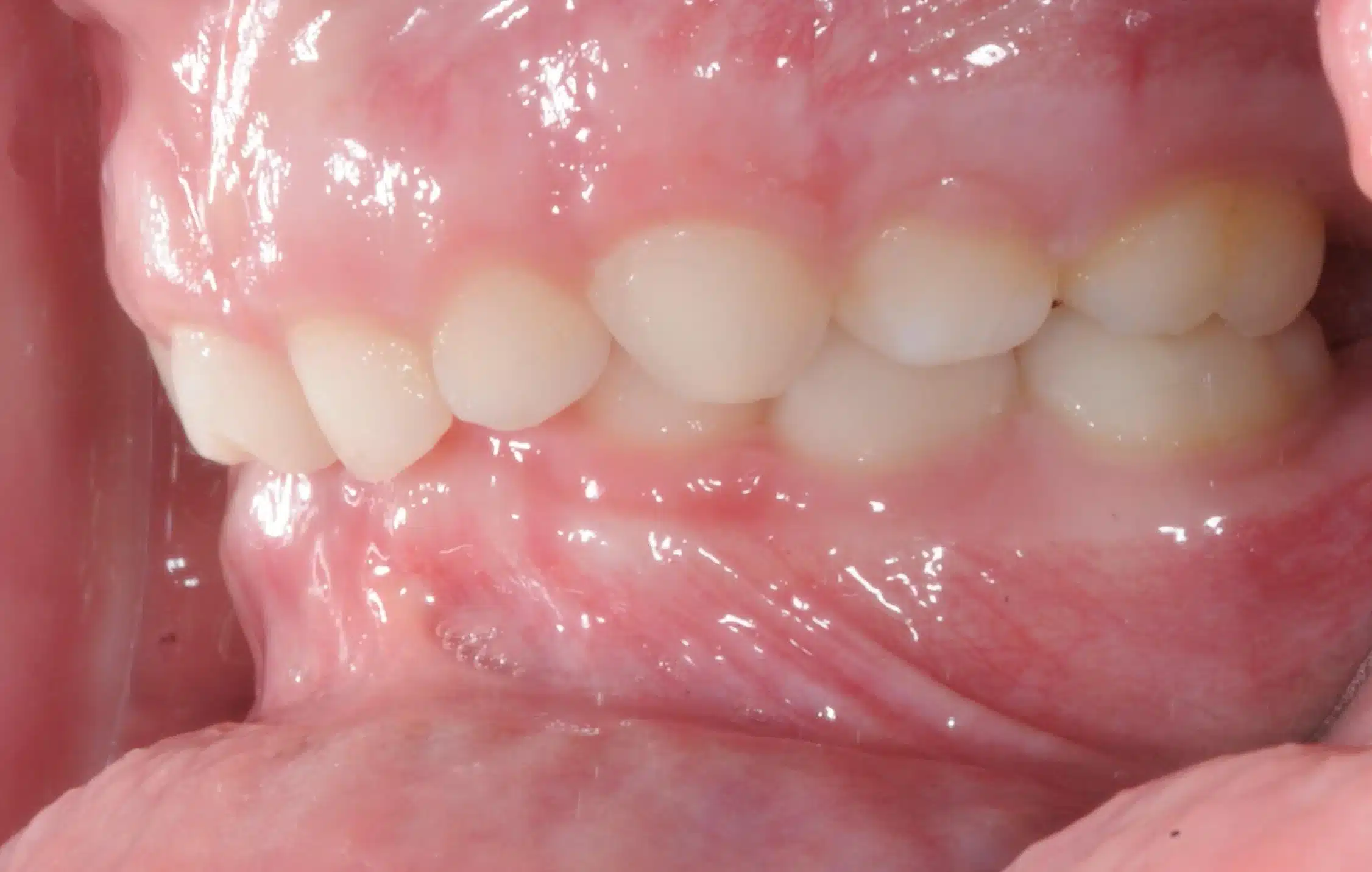 Why Early Orthodontics Treatment is essential (7).jpg