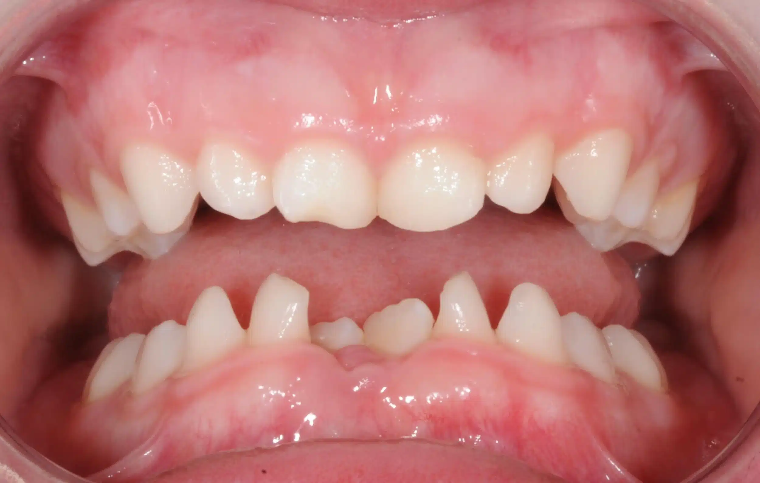 Why Early Orthodontics Treatment is essential (8).jpg