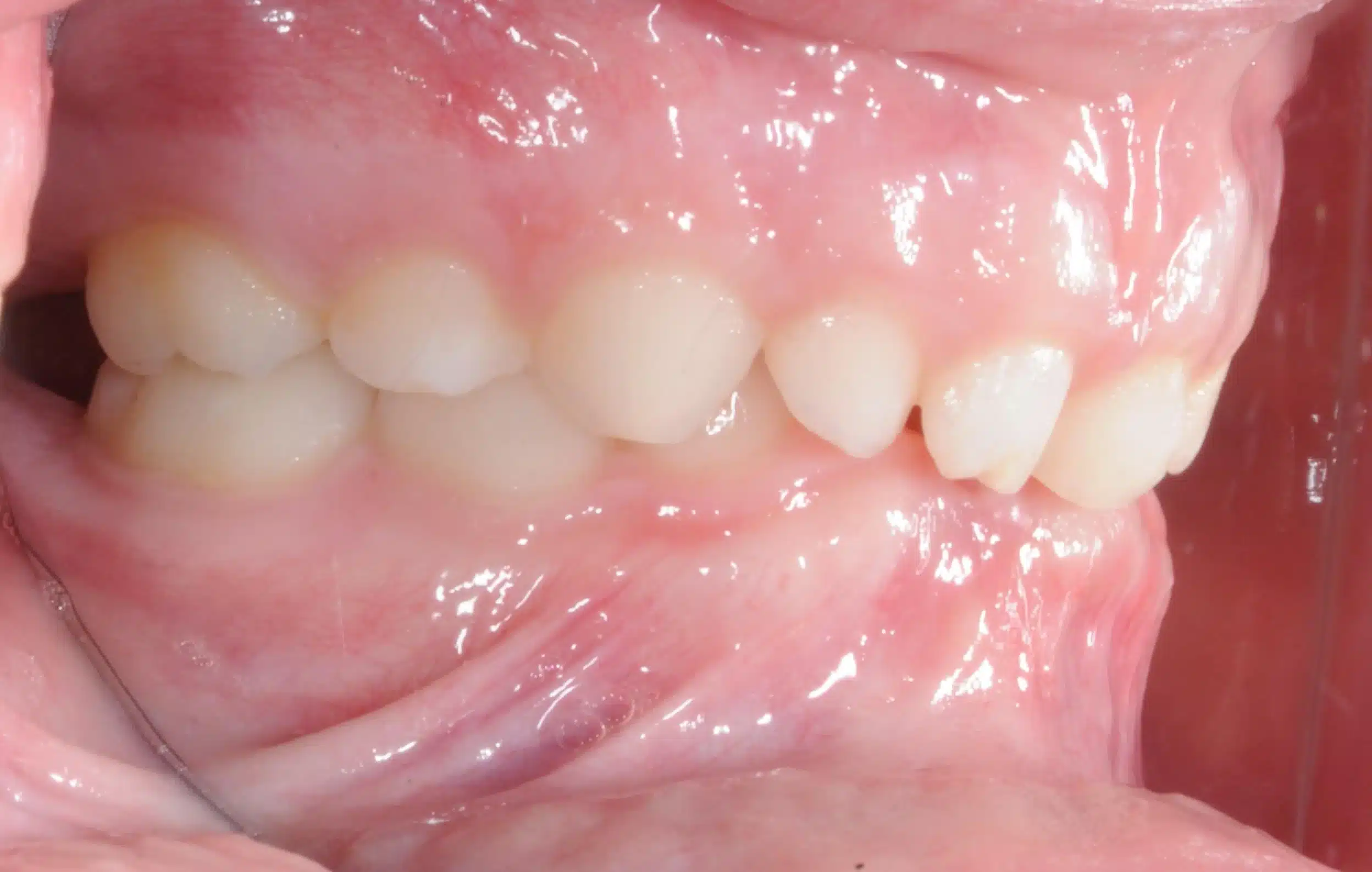 Why Early Orthodontics Treatment is essential (9).jpg
