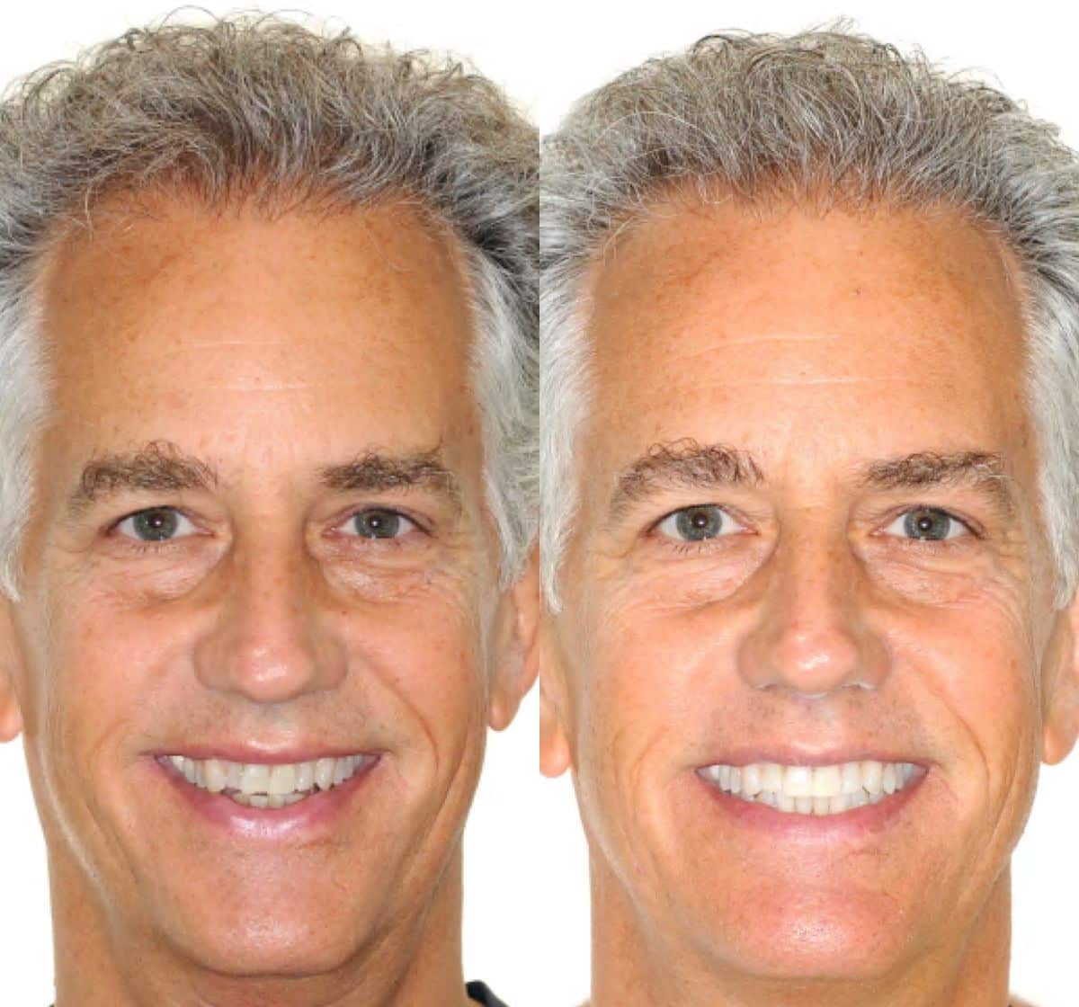 Adult orthodontics Manhattan before and after: a patient’s smile before and after treatment
